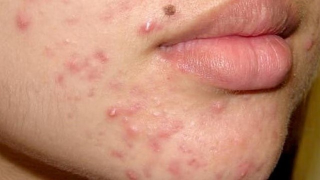 bai-viet/bat-mi-nhung-loai-kem-tri-mun-boc-tot-nhat-tren-thi-truong-hien-nay-65725.html