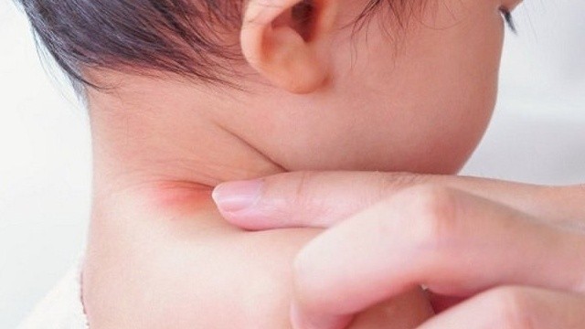 bai-viet/be-bi-ham-co-co-nen-boi-phan-rom-khong-cach-dieu-tri-hieu-qua-58612.html