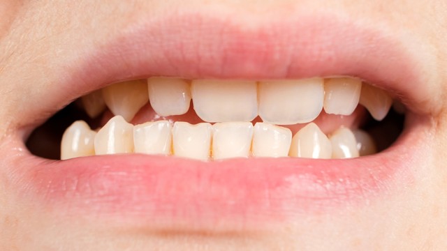 bai-viet/be-thay-rang-moc-lech-phai-lam-sao-cach-phong-ngua-va-xu-ly.html