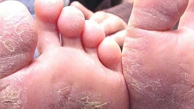 bai-viet/benh-a-sung-o-chan-nguyen-nhan-dau-hieu-va-cach-cai-thien-hieu-qua-69220.html