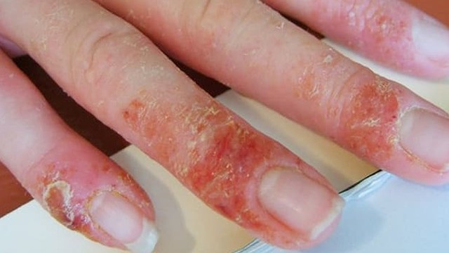 bai-viet/benh-a-sung-o-tay-meo-chua-tri-hieu-qua-bang-phuong-phap-dan-gian-69221.html