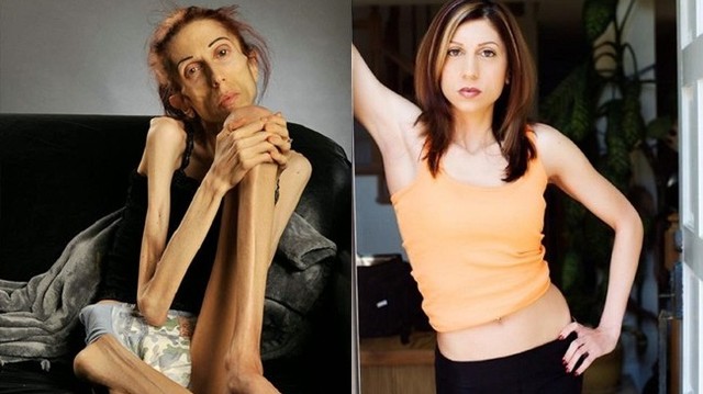 bai-viet/benh-anorexia-nguyen-nhan-trieu-chung-va-cach-dieu-tri.html