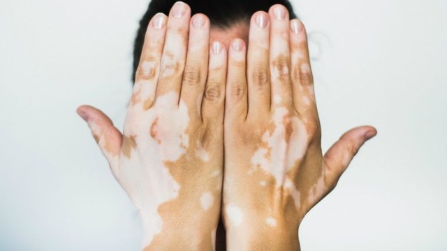 bai-viet/benh-bach-bien-kieng-an-gi-de-cai-thien-tinh-trang-benh-59401.html