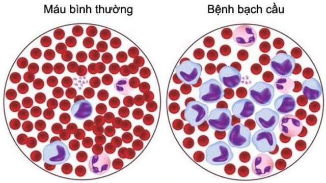 bai-viet/benh-bach-cau-te-bao-toc-la-gi-co-trieu-chung-the-nao.html