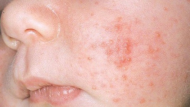 bai-viet/nguyen-nhan-va-cach-dieu-tri-hieu-qua-khi-tre-bi-cham-kho.html