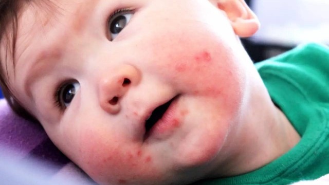 bai-viet/benh-chan-tay-mieng-can-kieng-gi-de-dat-hieu-qua-dieu-tri-72382.html