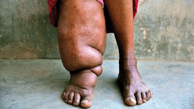 bai-viet/benh-chan-voi-phong-ngua-va-dieu-tri-nhu-the-nao.html