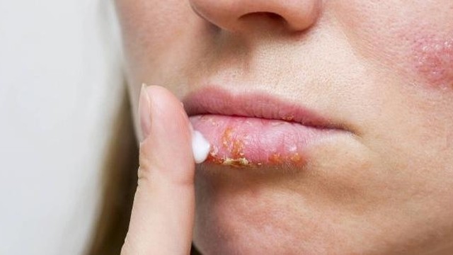 bai-viet/benh-choc-lo-dung-thuoc-gi-nhung-luu-y-khi-dieu-tri-benh-choc-lo.html