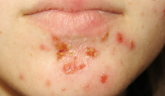 bai-viet/benh-choc-lo-nen-kieng-gi-de-nhanh-khoi-benh-56661.html