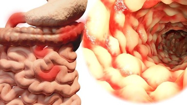 bai-viet/benh-crohn-cua-dai-trang-nguyen-nhan-va-phuong-phap-dieu-tri-hieu-qua-56881.html