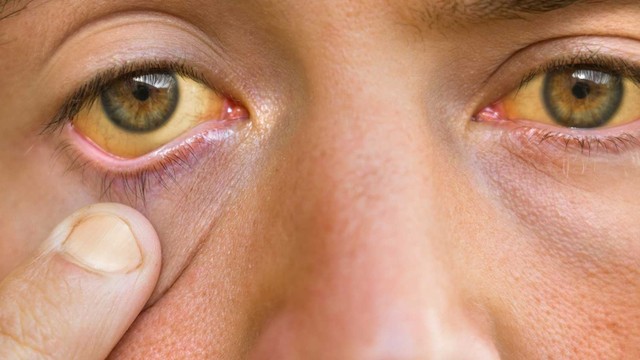 bai-viet/benh-gan-mat-nhan-biet-som-qua-4-trieu-chung-bat-thuong-cua-co-the.html