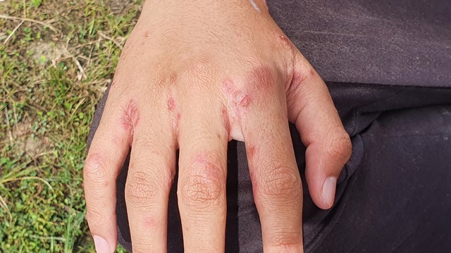 bai-viet/benh-ghe-co-lay-khong-dau-hieu-nhan-biet-va-cach-phong-ngua-hieu-qua.html