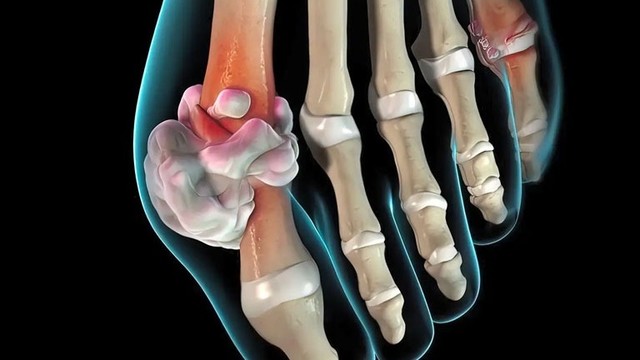 bai-viet/benh-gut-vo-can-co-nguy-hiem-khong.html