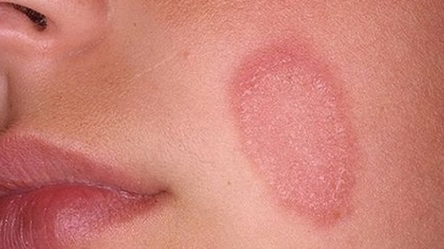 bai-viet/benh-hac-lao-co-bi-o-mat-khong-phuong-phap-chua-hac-lao-tai-nha-55471.html