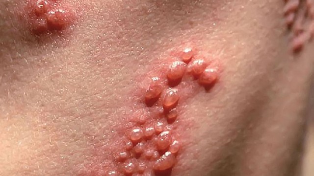 bai-viet/benh-herpes-co-chua-khoi-duoc-khong-va-chua-bang-cach-nao.html