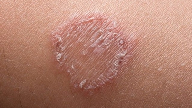 bai-viet/benh-lac-dong-tien-co-lay-khong-cach-phong-ngua-hieu-qua-72812.html