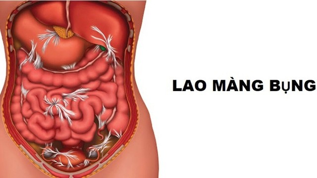 bai-viet/benh-lao-mang-bung-co-nguy-hiem-khong.html
