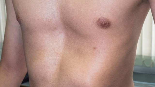 bai-viet/benh-lom-nguc-nguyen-nhan-bien-chung-va-dieu-tri-61102.html