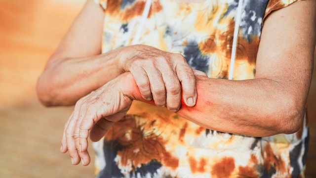 bai-viet/benh-lupus-ban-do-co-nguy-hiem-khong.html