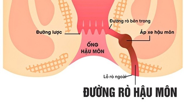 bai-viet/benh-ly-ro-hau-mon-co-nguy-hiem-khong.html