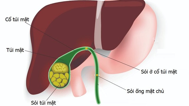 bai-viet/benh-ly-tui-mat-la-gi-trieu-chung-nguyen-nhan-va-cach-chan-doan.html