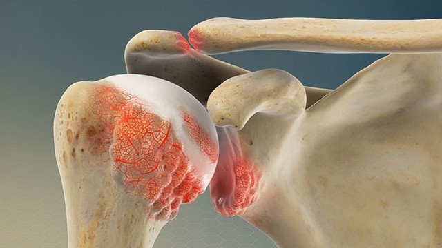 bai-viet/benh-nhan-thoai-hoa-khop-vai-nen-an-gi-51163.html