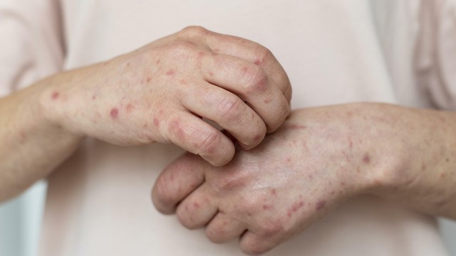 bai-viet/co-nhung-cach-tri-noi-me-day-tai-nha-nao-nguyen-nhan-gay-noi-me-day.html