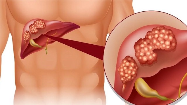 bai-viet/benh-san-la-gan-o-nguoi-co-nguy-hiem-khong.html