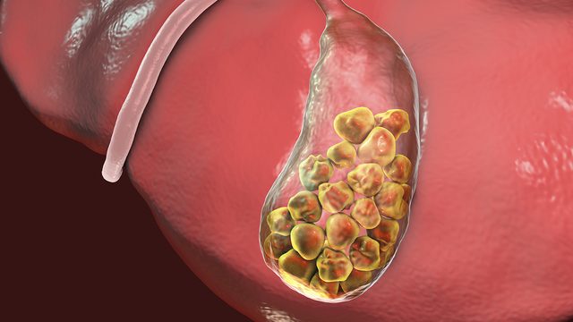 bai-viet/benh-soi-tui-mat-co-nguy-hiem-khong-phong-ngua-the-nao.html