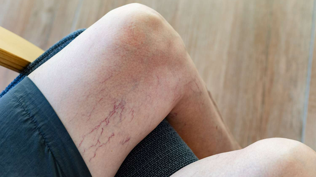 bai-viet/benh-suy-gian-tinh-mach-o-dui-la-gi.html