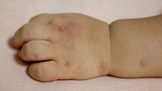 bai-viet/benh-tay-chan-mieng-do-2-trieu-chung-nguy-co-va-cach-phong-tranh.html