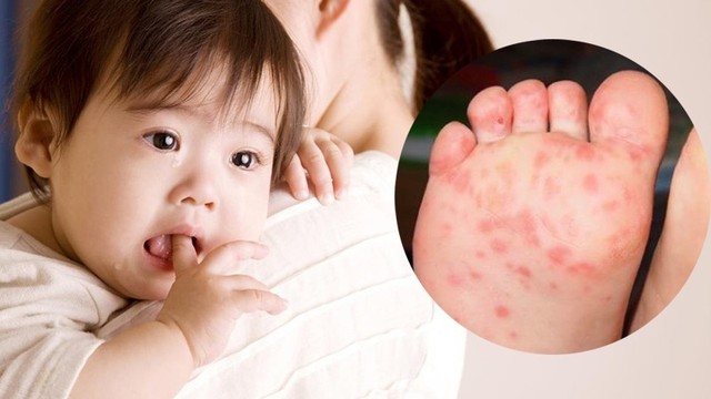 bai-viet/benh-tay-chan-mieng-co-lay-khong-cach-phong-tranh-benh-nhu-the-nao-72413.html