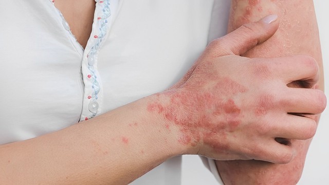 bai-viet/khai-quat-ve-cac-benh-tu-mien-ngoai-da-thuong-gap-nhat.html