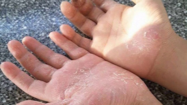 bai-viet/benh-vay-nen-a-sung-co-lay-khong-40133.html