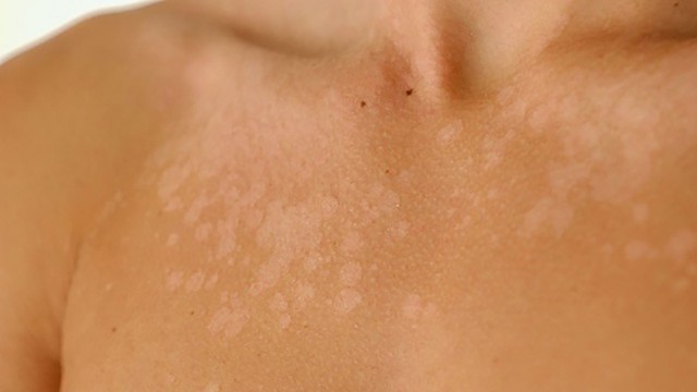 bai-viet/benh-vay-phan-trang-nguyen-nhan-va-cach-dieu-tri.html