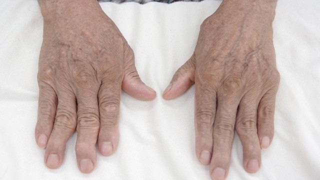 bai-viet/benh-viem-da-khop-co-chua-duoc-khong-nhung-dieu-can-biet.html