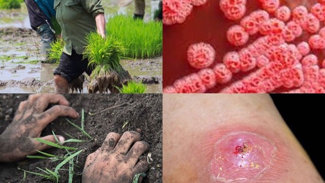 bai-viet/benh-whitmore-co-chua-duoc-khong-tim-hieu-ve-phuong-phap-dieu-tri-hieu-qua.html