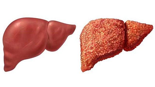 bai-viet/benh-xo-gan-co-may-giai-doan-cach-phong-tranh-xo-gan-nhu-the-nao.html