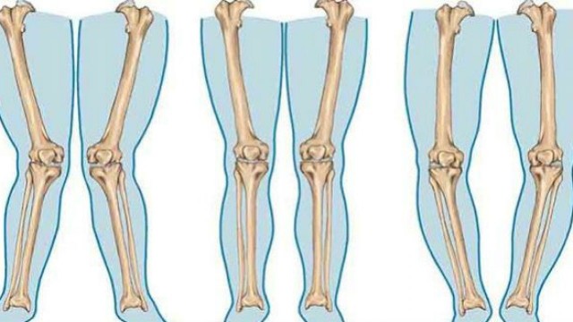 bai-viet/benh-xuong-thuy-tinh-co-di-truyen-khong-61091.html