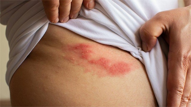 bai-viet/benh-zona-co-nguy-hiem-khong-cac-bien-chung-cua-zona-than-kinh-co-the-gap-phai.html