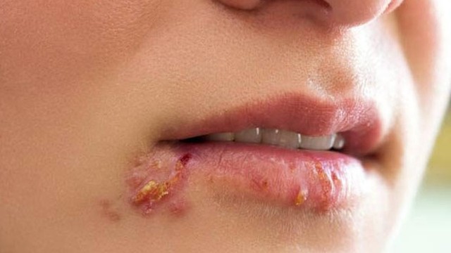 bai-viet/benh-zona-than-kinh-o-mat-va-nhung-dieu-can-biet.html