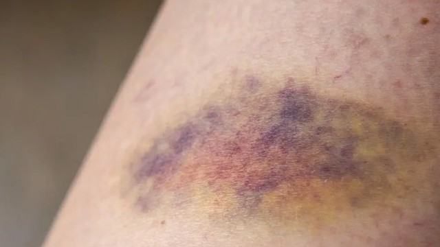 bai-viet/bi-bam-tim-khong-ro-nguyen-nhan-phai-lam-sao-cach-giam-vet-bam-tim-nhanh-chong-59701.html