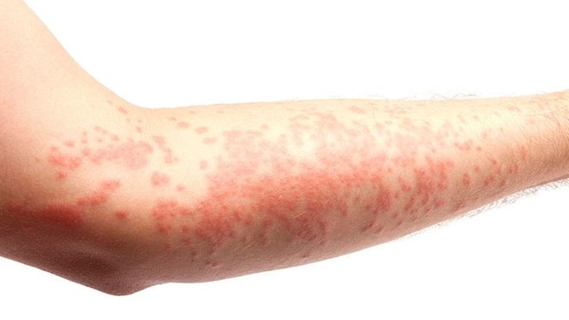 bai-viet/bi-benh-me-day-man-tinh-kieng-an-gi-de-nhanh-khoi-54440.html