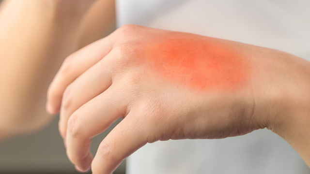 bai-viet/bi-bong-boi-gi-va-khong-nen-boi-gi-de-vet-thuong-nhanh-lanh.html