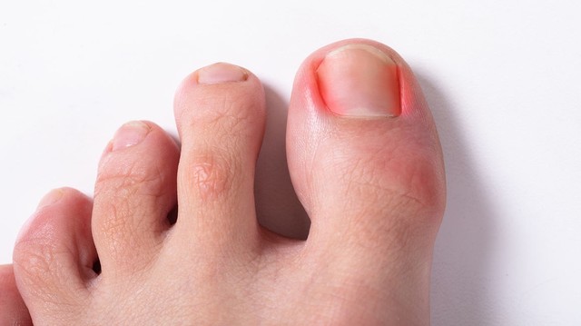 bai-viet/bi-chin-me-bao-lau-thi-khoi-cach-chua-chin-me-cuc-don-gian-tai-nha-69465.html