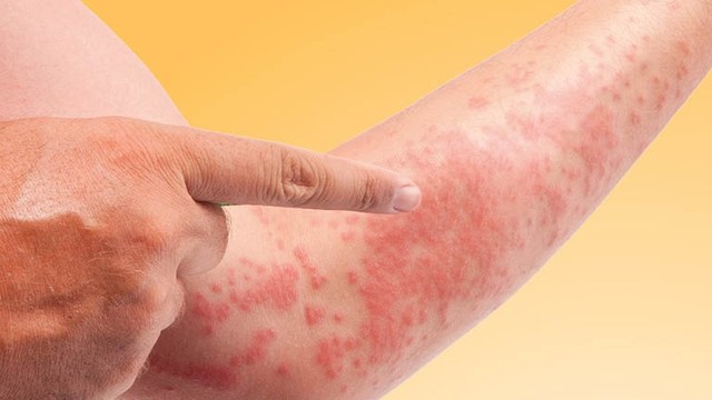 bai-viet/bi-di-ung-thoi-tiet-phai-lam-sao-huong-dan-chi-tiet-de-kiem-soat-tinh-trang-kho-chiu.html