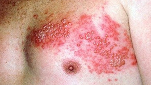 bai-viet/bi-gioi-leo-boi-thuoc-7-mau-duoc-khong-can-luu-y-nhung-gi-khi-su-dung-thuoc.html