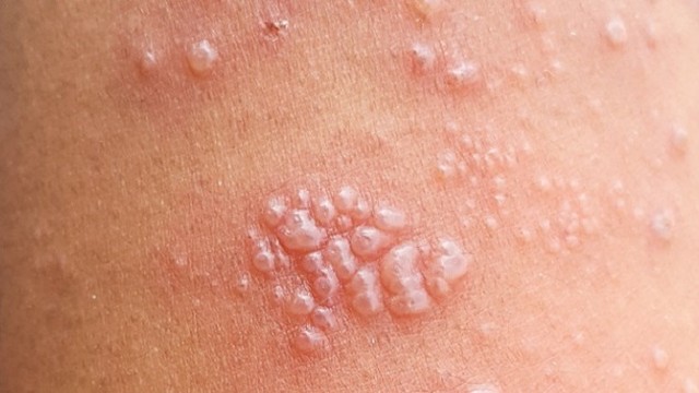 bai-viet/bi-gioi-leo-kieng-an-gi-de-nhanh-het-benh.html