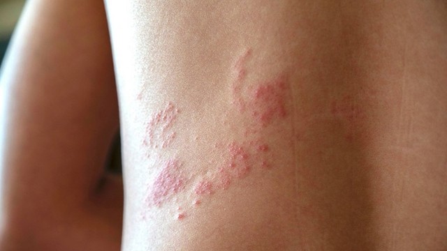 bai-viet/bi-gioi-leo-kieng-gi-an-gi-de-nhanh-khoi-benh.html