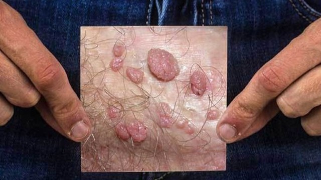 bai-viet/bi-ngua-vung-hang-o-nam-nguyen-nhan-do-dau.html